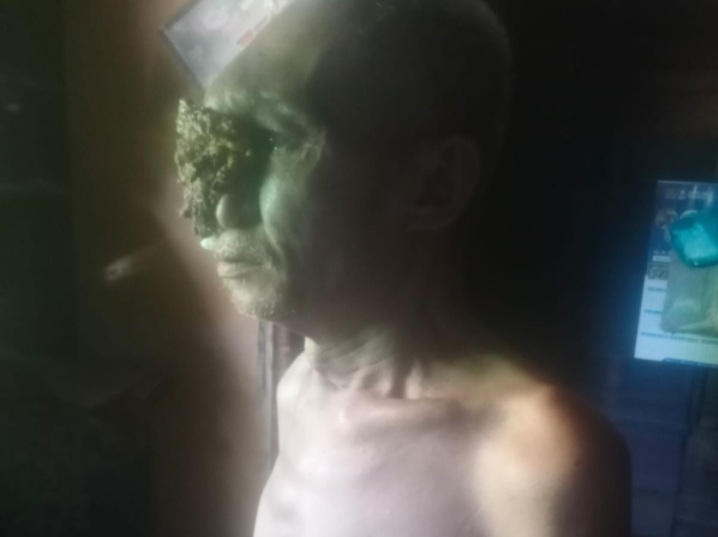 Ali Napia Penderita ” Tumor Ganas ” Membutuhkan Biaya