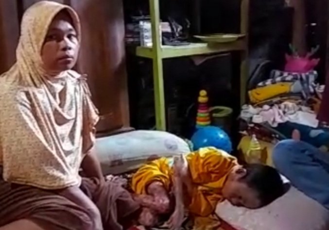 M.Raihan.Lubis 9 Tahun Kena Penyakit Kulit Butuh Perhatian Semua Pihak