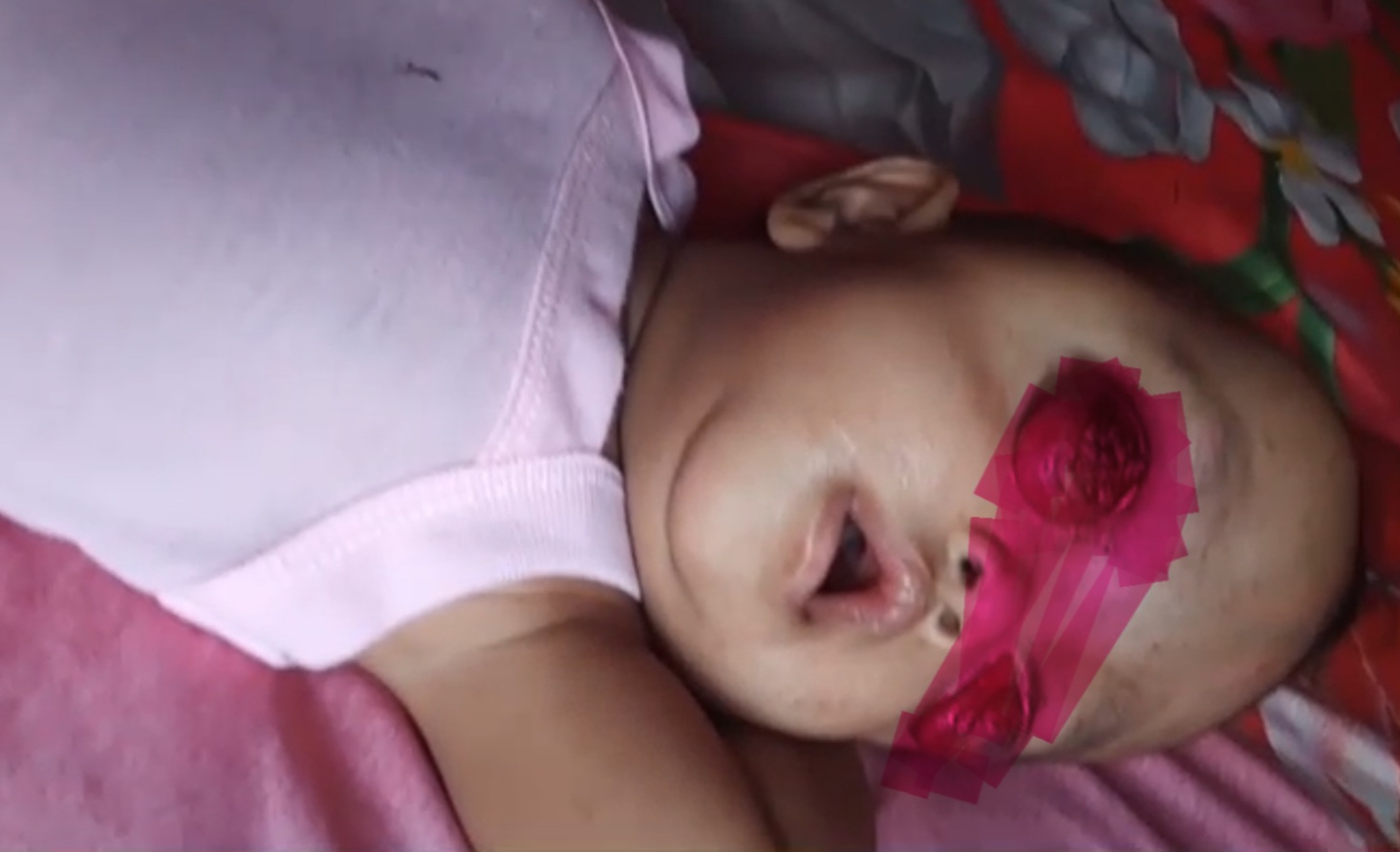 Balita Idap Kanker Mata, Orang Tua Butuh Bantuan Biaya Berobat